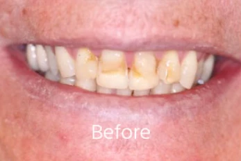 Before Cosmetic Dentistry Case 2