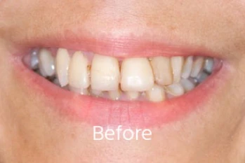Before Cosmetic Dentistry Case 3