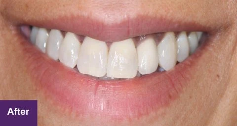 After Dental Implant Case 1