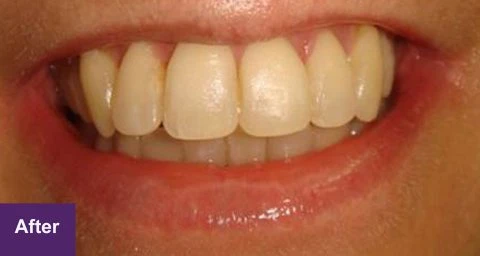 After Restorative Case 1