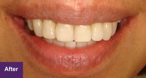 After Dental Implant Case 3