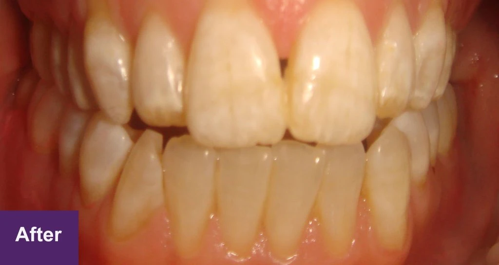 After Restorative Case 2