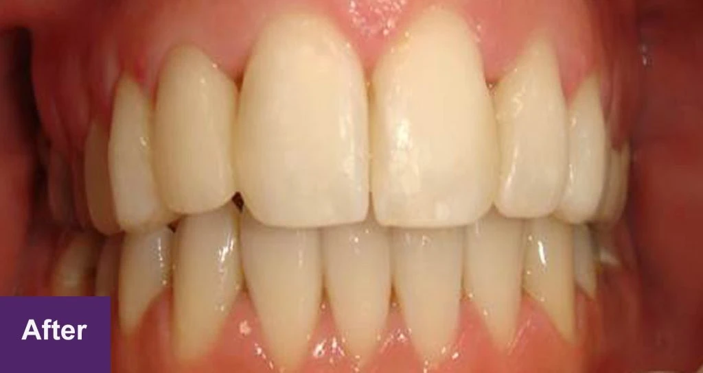 After Restorative Case 3