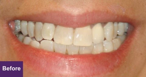 Before Dental Implant Case 1