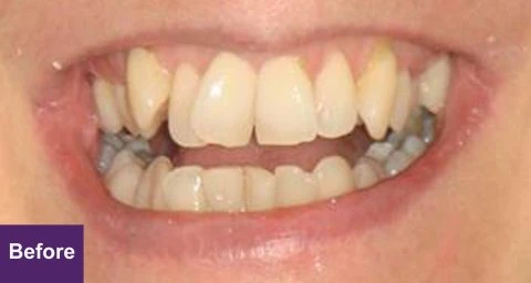 Before Restorative Case 1