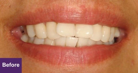 Before Dental Implant Case 3