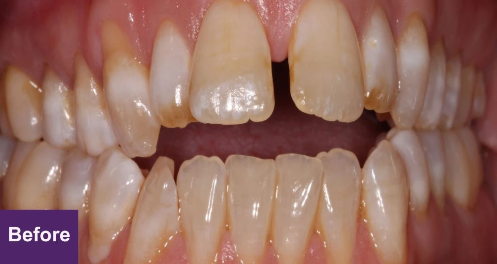 Before Restorative Case 2