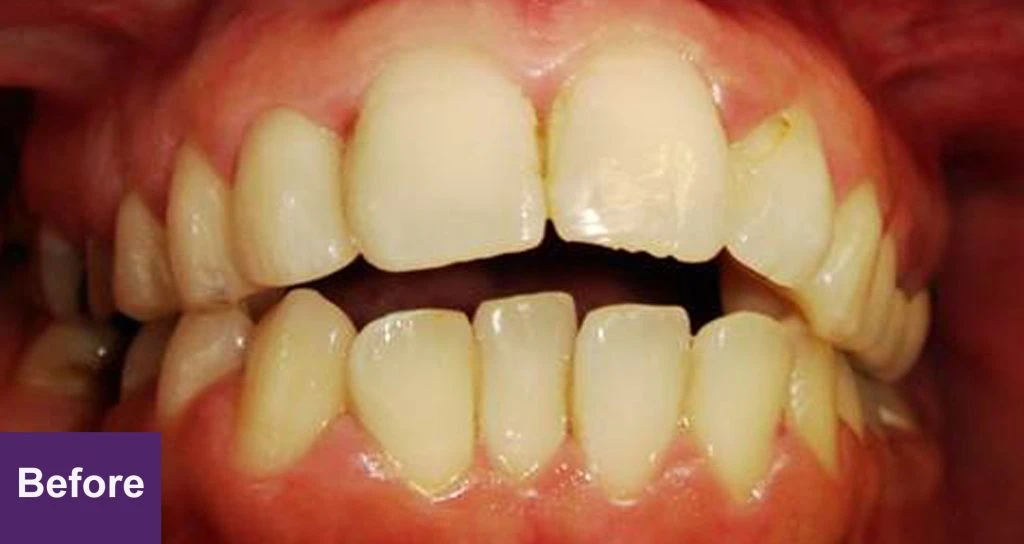 Before Restorative Case 3
