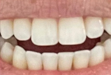 After Invisalign Alignment Transformation 2