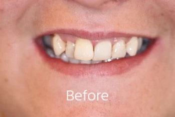 Before Teeth Straightening Transformation 3
